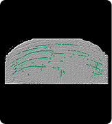 Forehead wrinkles baseline 3D scan