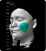 Cheek volume week 4 3D scan